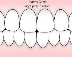 gum disease diagram