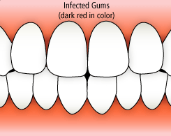 gum disease diagram