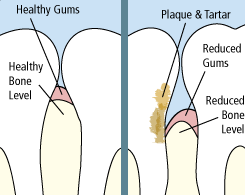 gum disease diagram